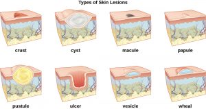 primary skin lesions chart