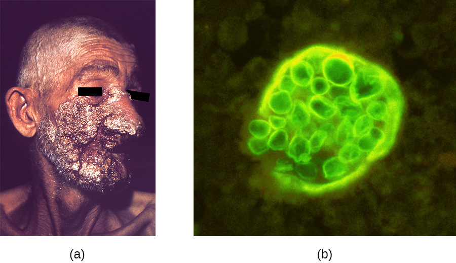 a) Large, dark lesions on a face. B) A micrograph of spheres in a larger sphere.