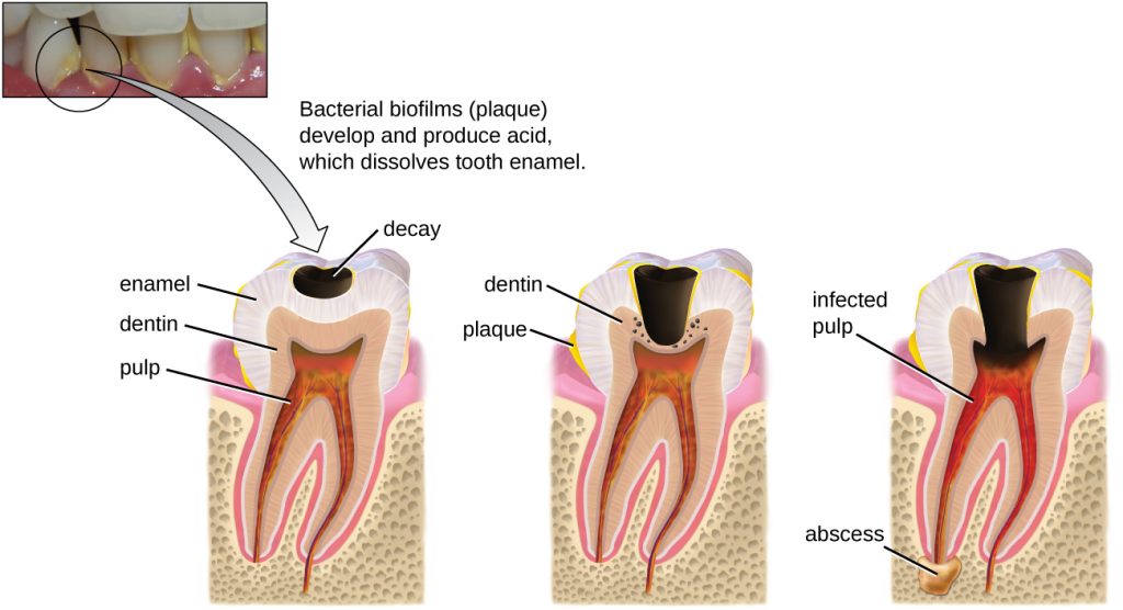 A photo of teeth with yellow plaque and diagrams of the stages of tooth decay.