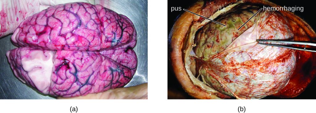 a) Photo of brain. B) Photo of thin layer on top of brain being pulled back by forceps.
