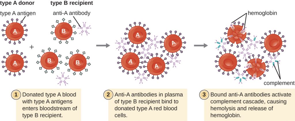 Diagram of the hypersensitivity reaction that occurs when a Type A donor gives blood to a Type B recipient.