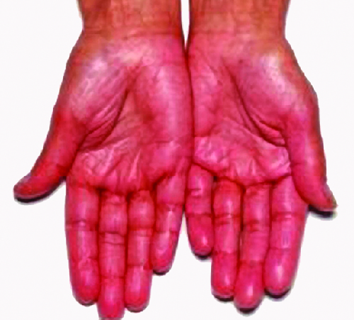 Two hands, palm up are shown. They display a symptom of Addison disease: they are quite red.