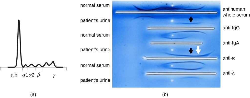 A graph and experimental results from an immunoelectrophoresis assay of a patient's urine.