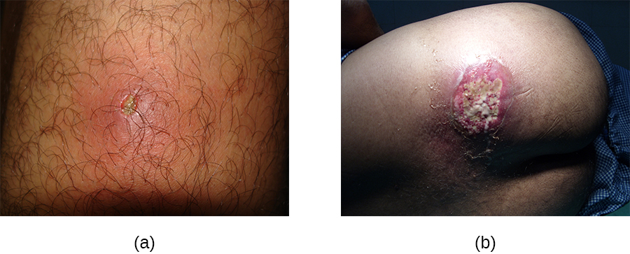 a) a photo of a small inflamed region with a white centre. b) A large lesion with white and red.
