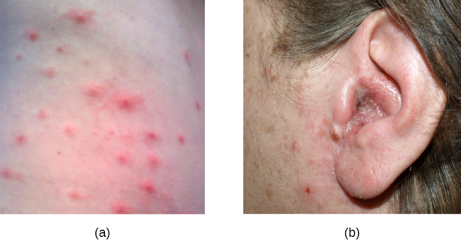 a) photo of hot tub rash that looks like acne b) photo of swollen ear.