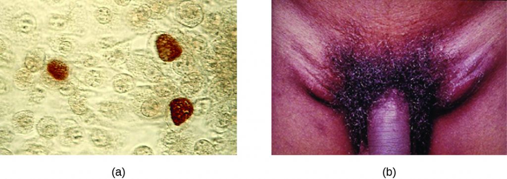 a) Micrograph showing brown colouration inside cells. B) photo of a swollen region on either side of the penis.