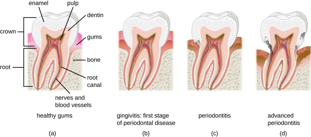 Diagram of a tooth with healthy gums compared to diagrams of teeth with differing levels of periodontal disease.