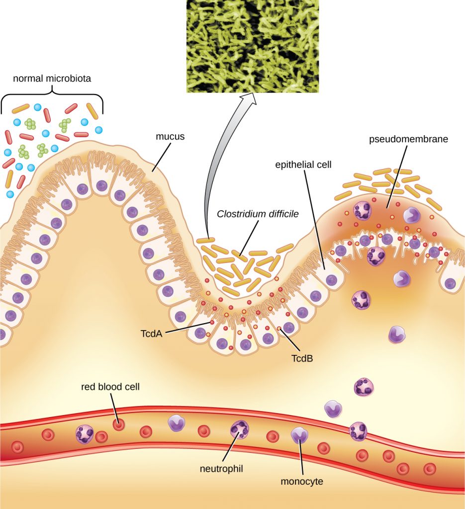 A diagram showing how Clostridium difficile is able to colonize the mucous membrane of the colon when the normal microbiota is disrupted.